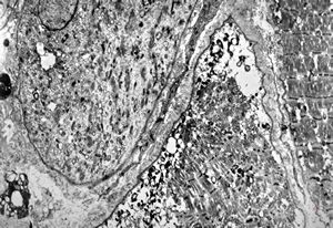 F,66y. | myositis F,66y. | myositis